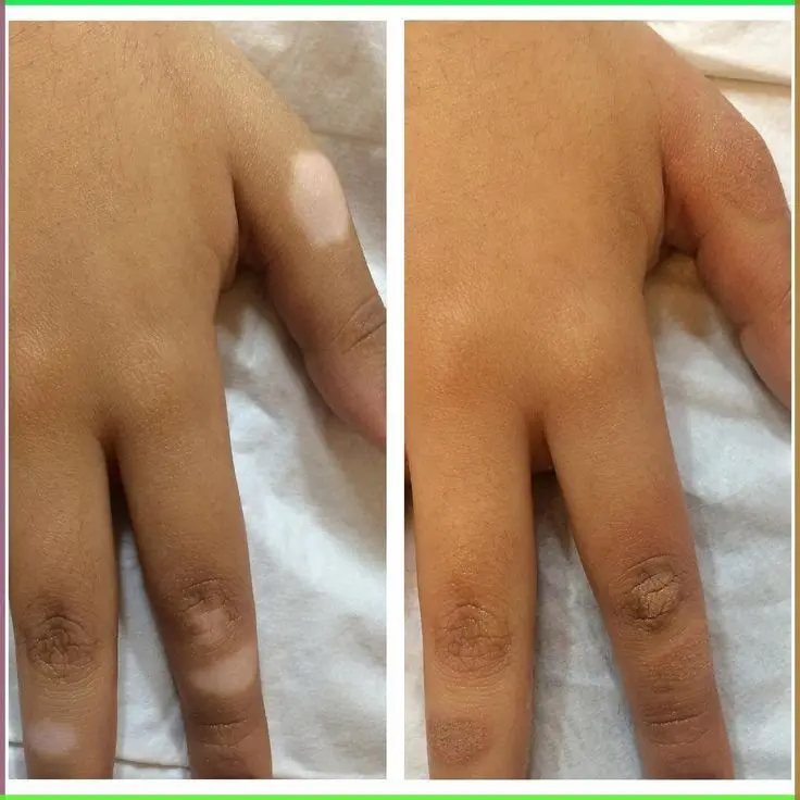 Scar Camouflage example — Trendy Tattoo & Piercing Studio, Vijayawada